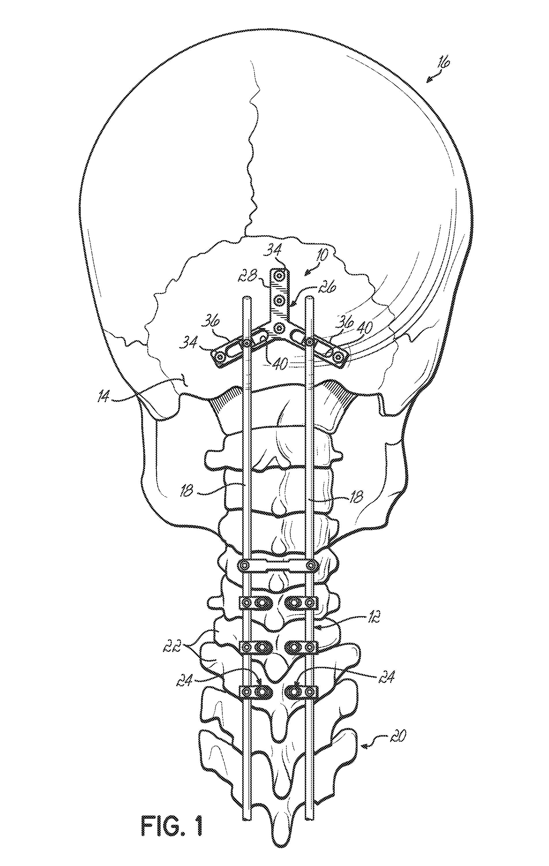 Adjustable occipital plate