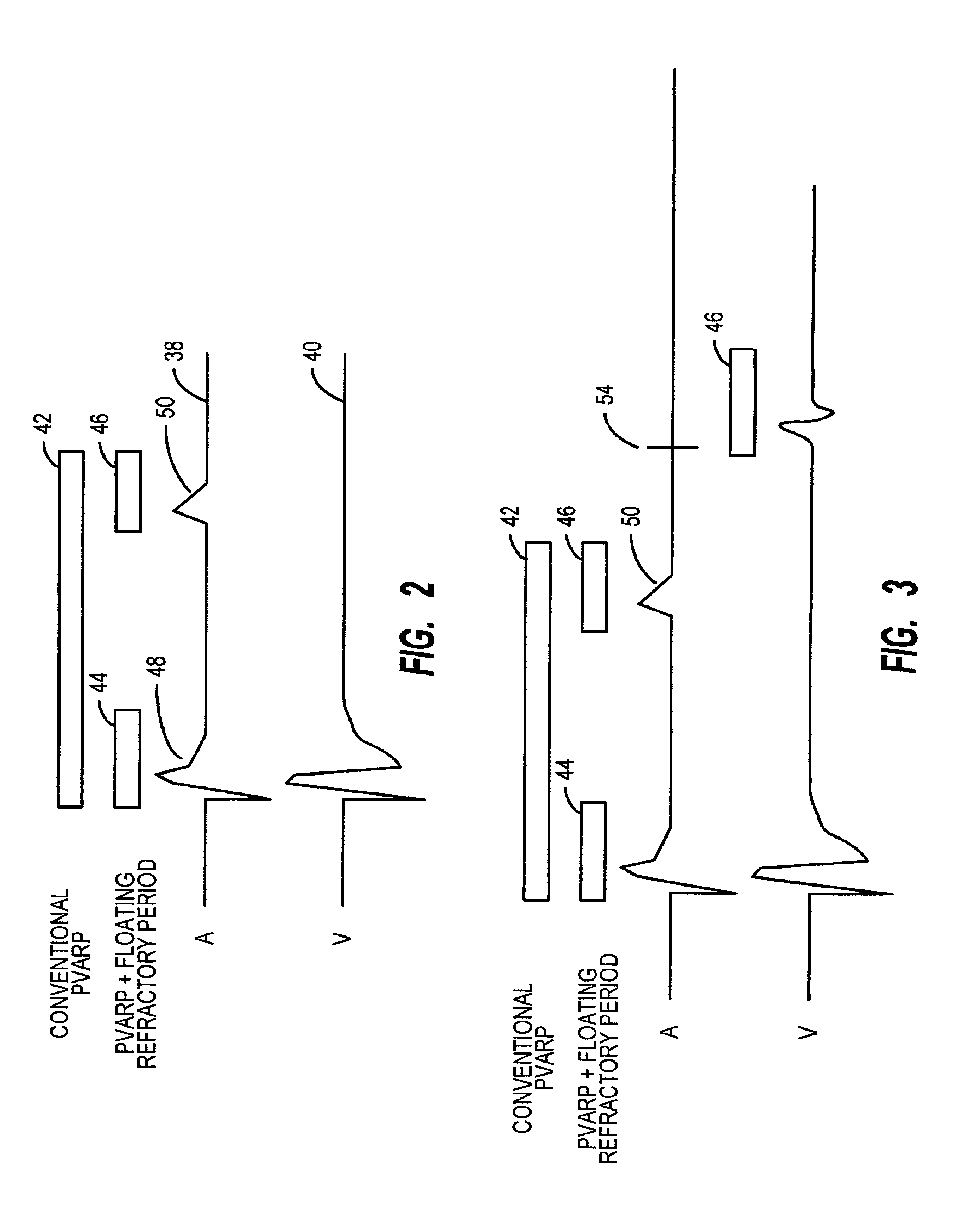 Method and apparatus for avoiding unwanted sensing in a cardiac rhythm management device