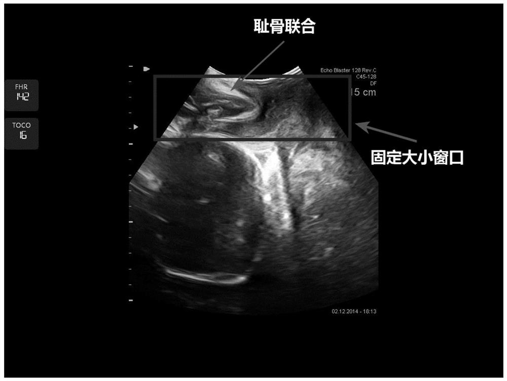 A method for automatic measurement of fetal head descent angle