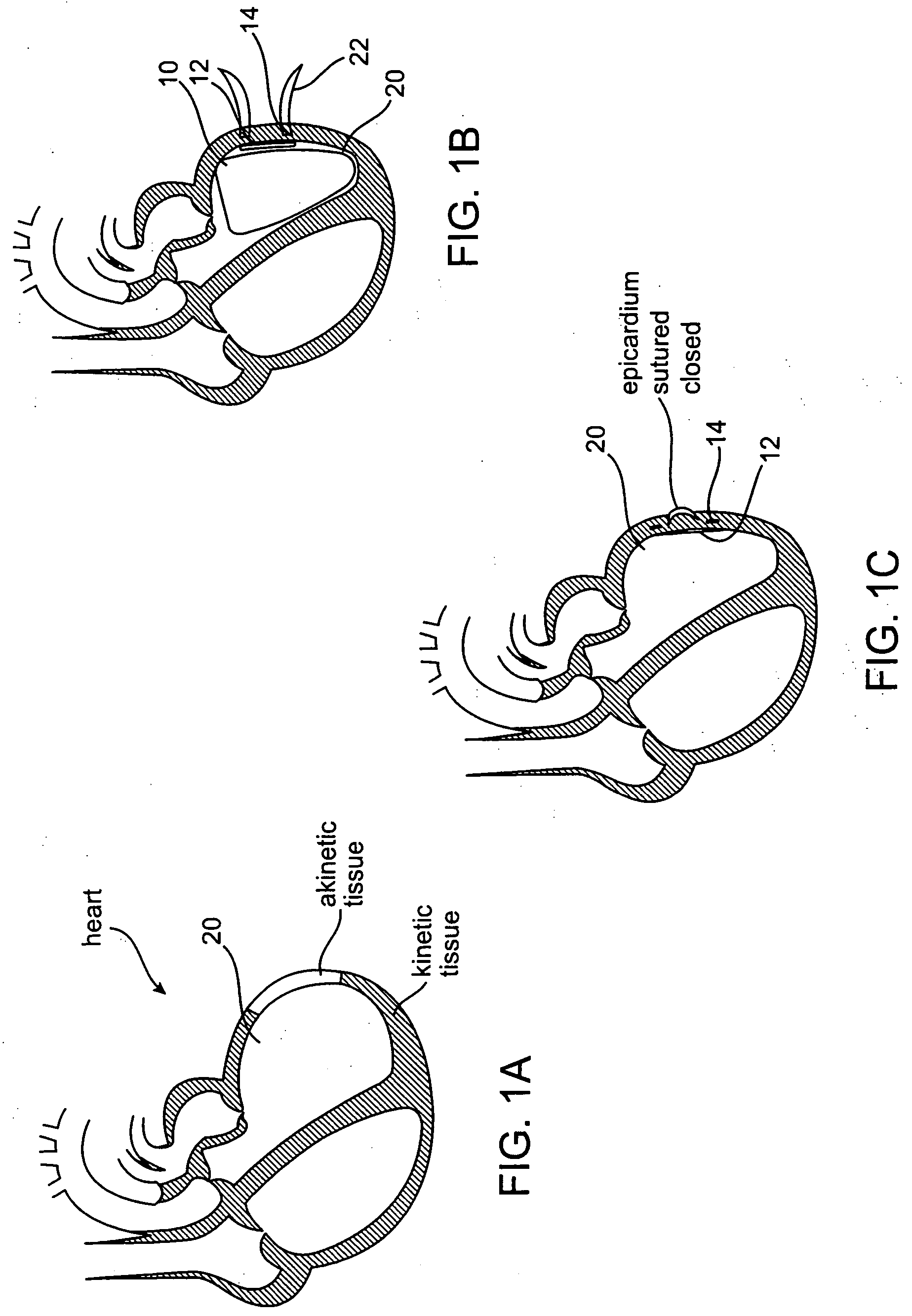 Hemostatic patch for treating congestive heart failure