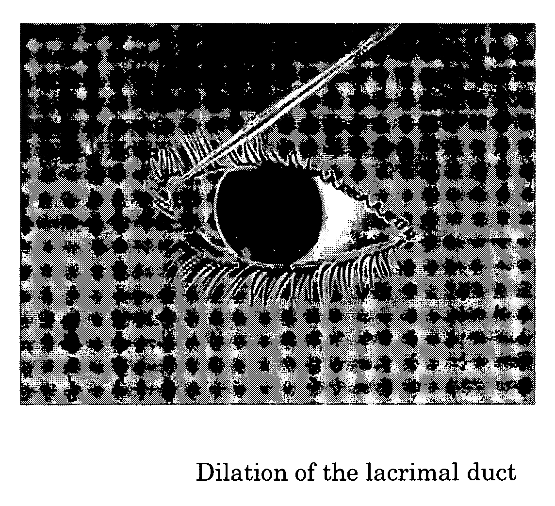 Method of intracanalicular laser dacryocystorhinostomy