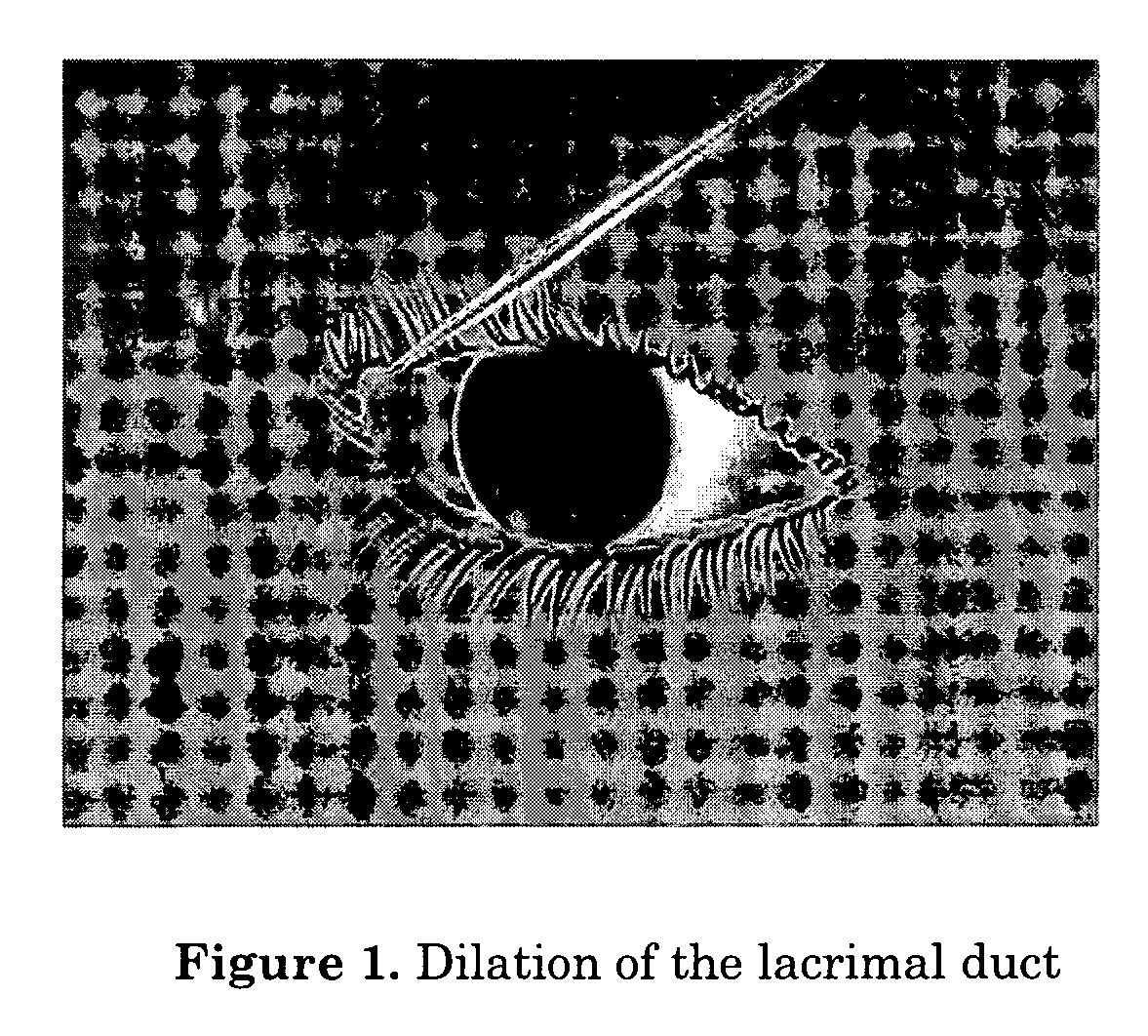 Method of intracanalicular laser dacryocystorhinostomy