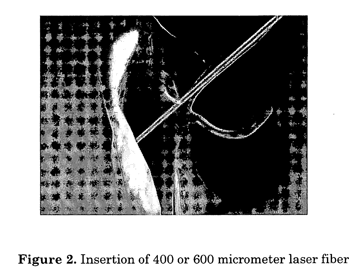 Method of intracanalicular laser dacryocystorhinostomy