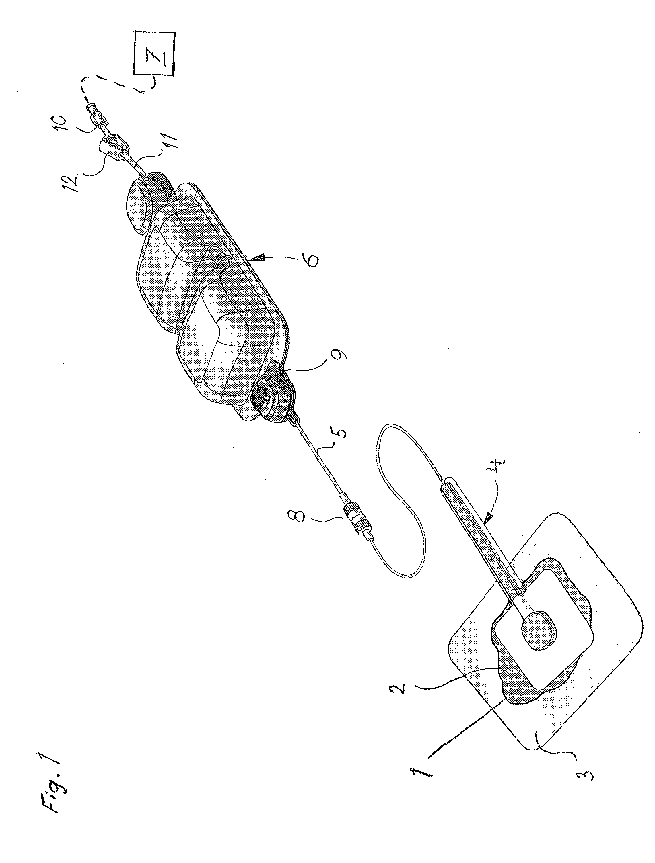 Device for tratment of wound using reduced pressure