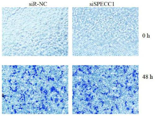 CircSPECC1 for treating human kidney cancer and application thereof