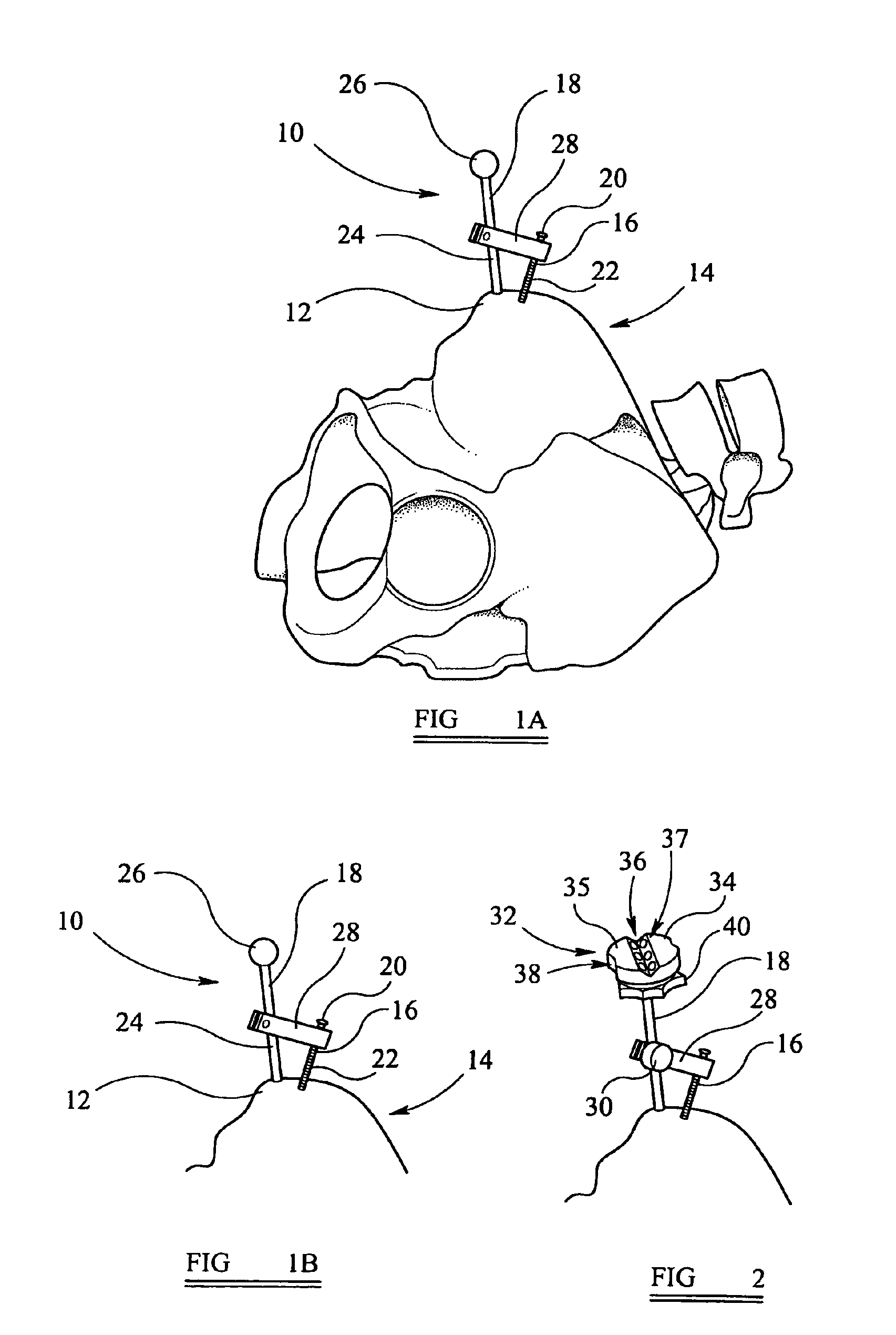 Alignment device