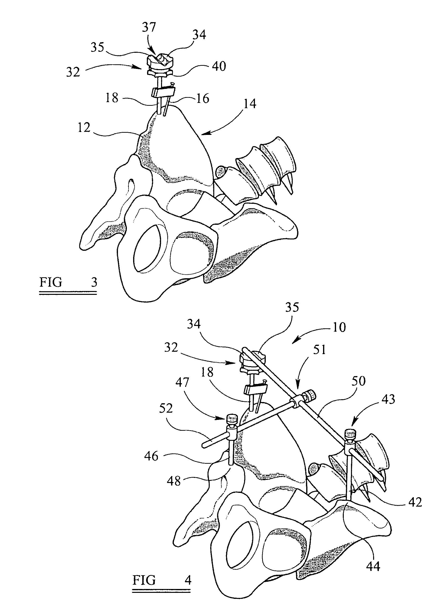 Alignment device