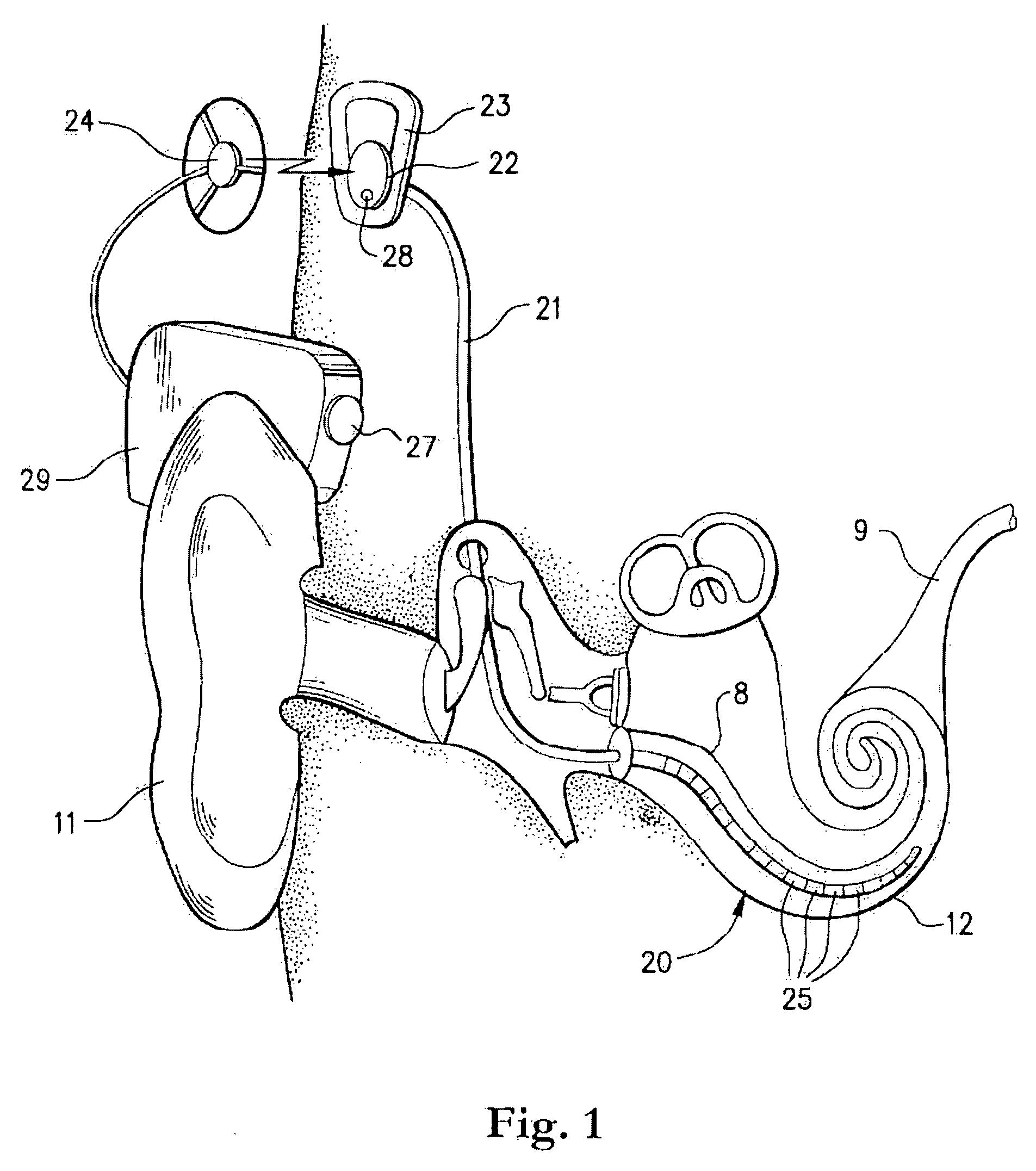 Cochlear implant fitting