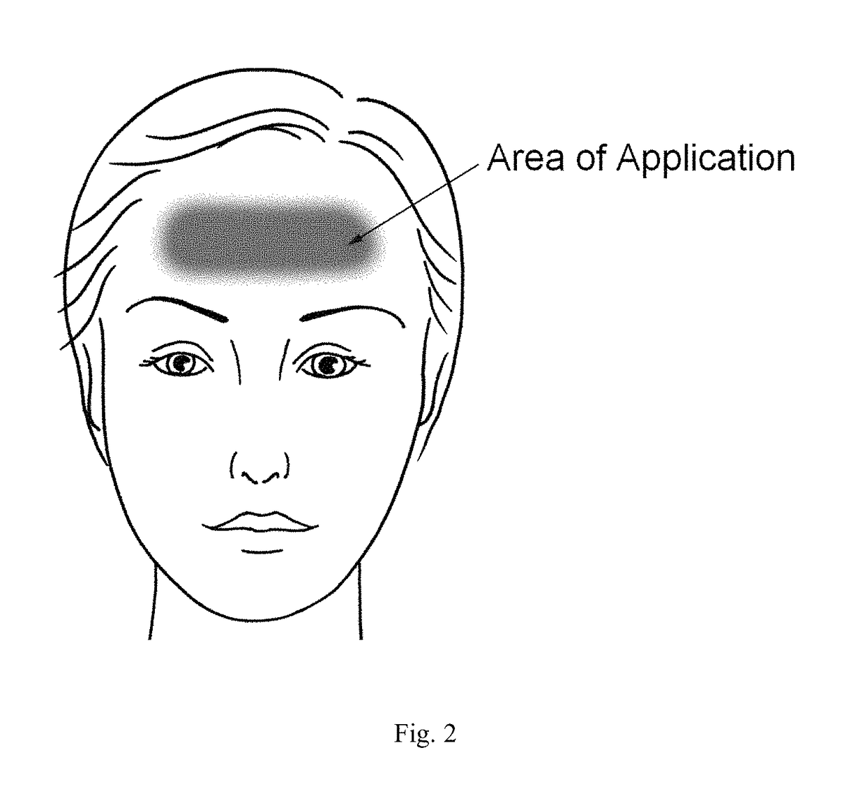 Treatment of symptoms related to neurodegenerative disorders through pharmacological dermal activation of cranial nerves