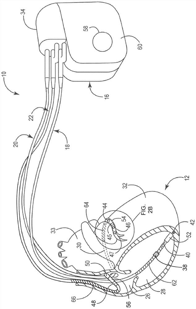 Non-invasive detection of phrenic nerve stimulation