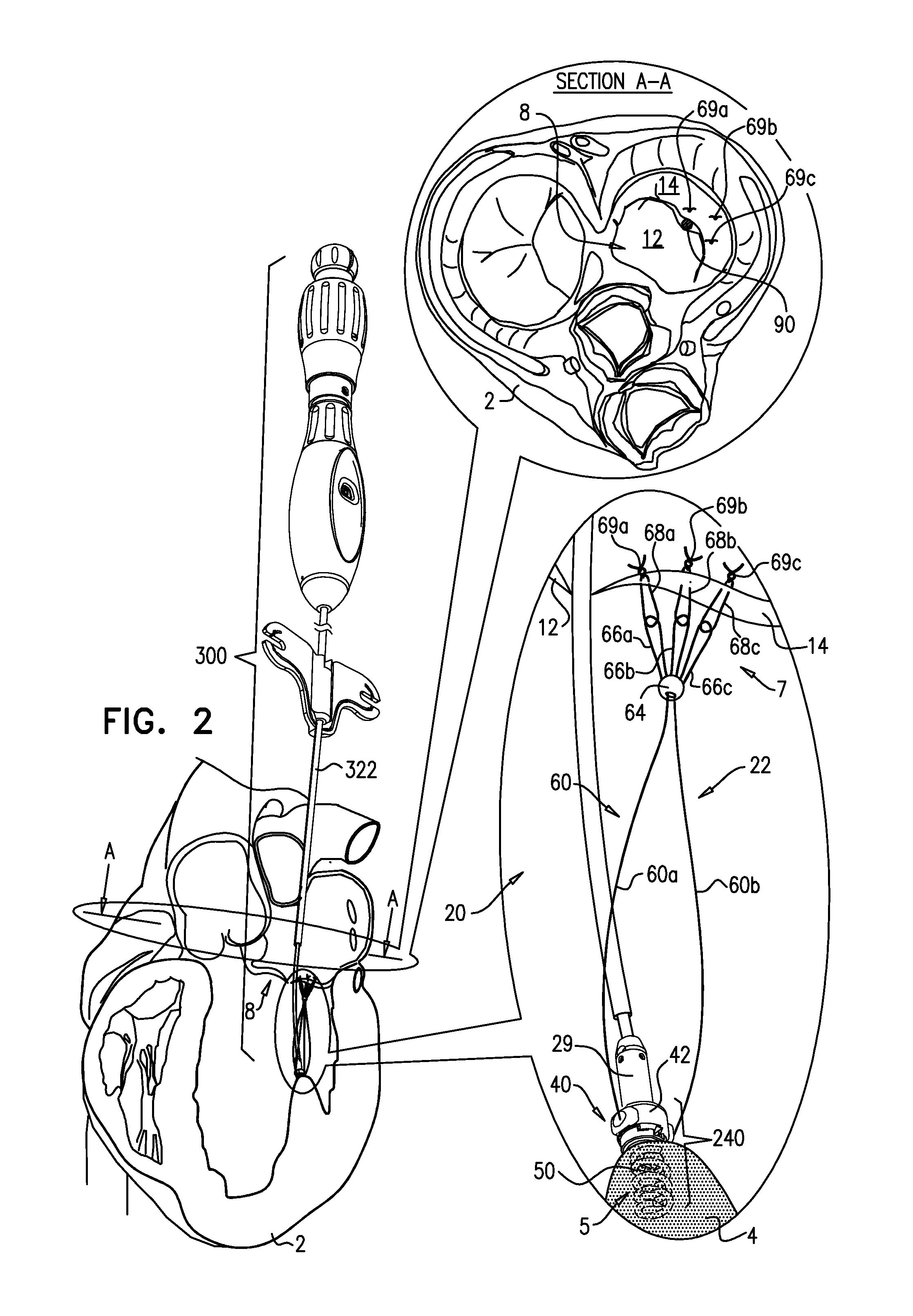 Adjustable artificial chordeae tendineae with suture loops