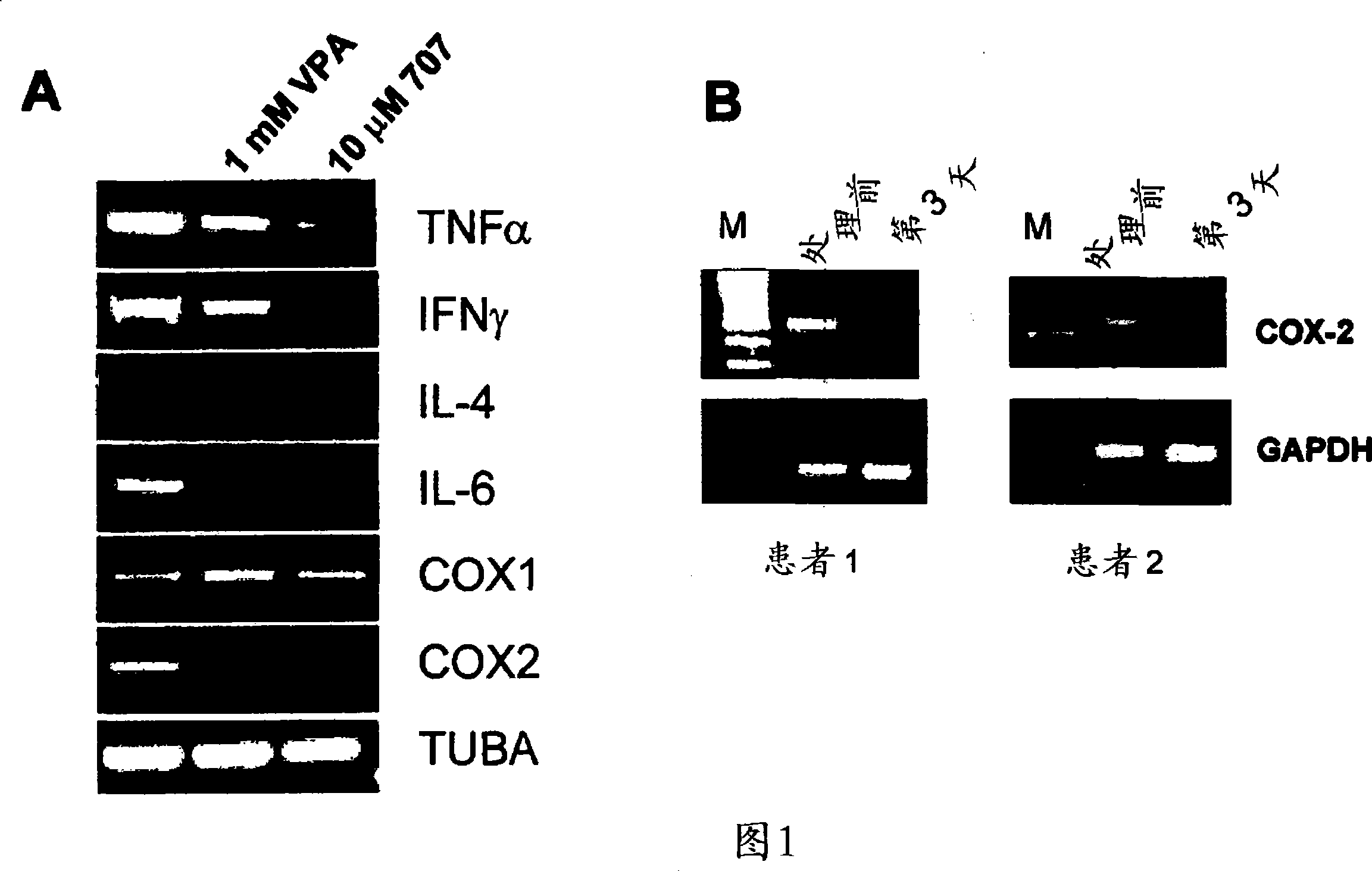 Use of inhibitors of histone deacetylases in combination with NASAID for the therapy of cancer and/or inflammatory diseases