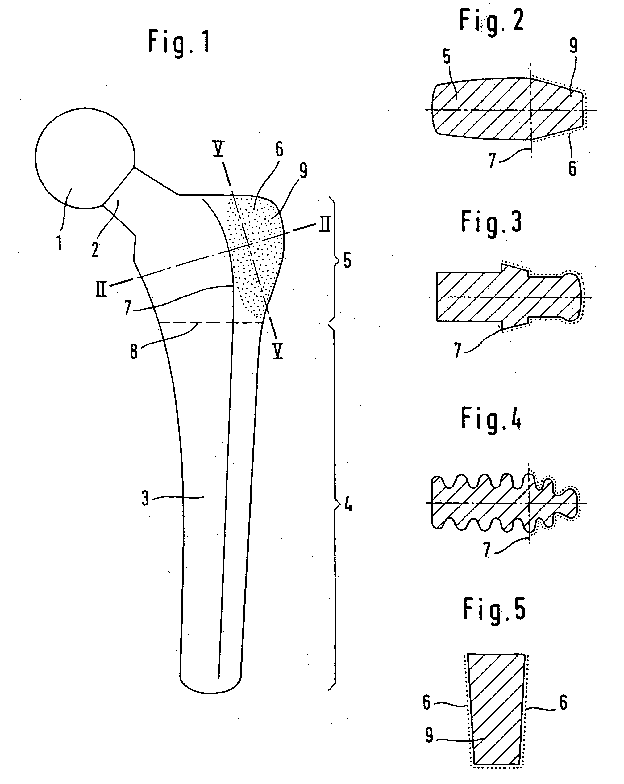 Hip Joint Prosthesis with a Shaft to be Inserted Into the Femur