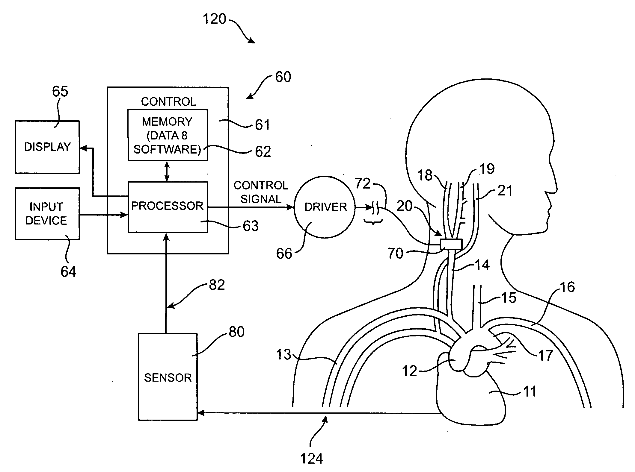 Baroreflex activation therapy with conditional shut off