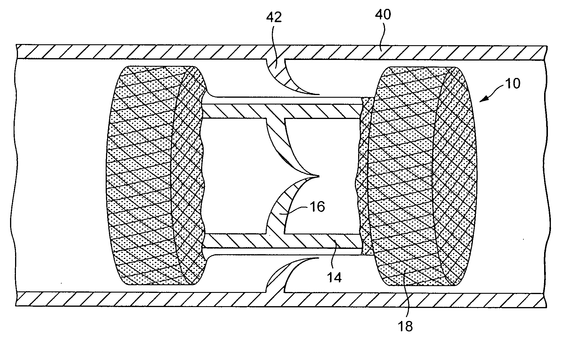 Method And Apparatus For Treatment Of Cardiac Valves