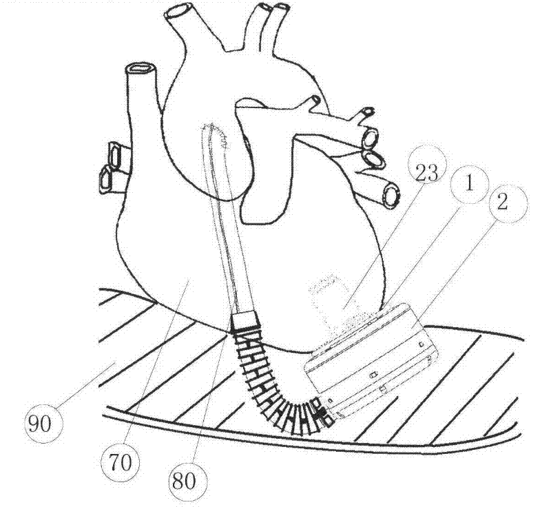 left ventricular assist pump