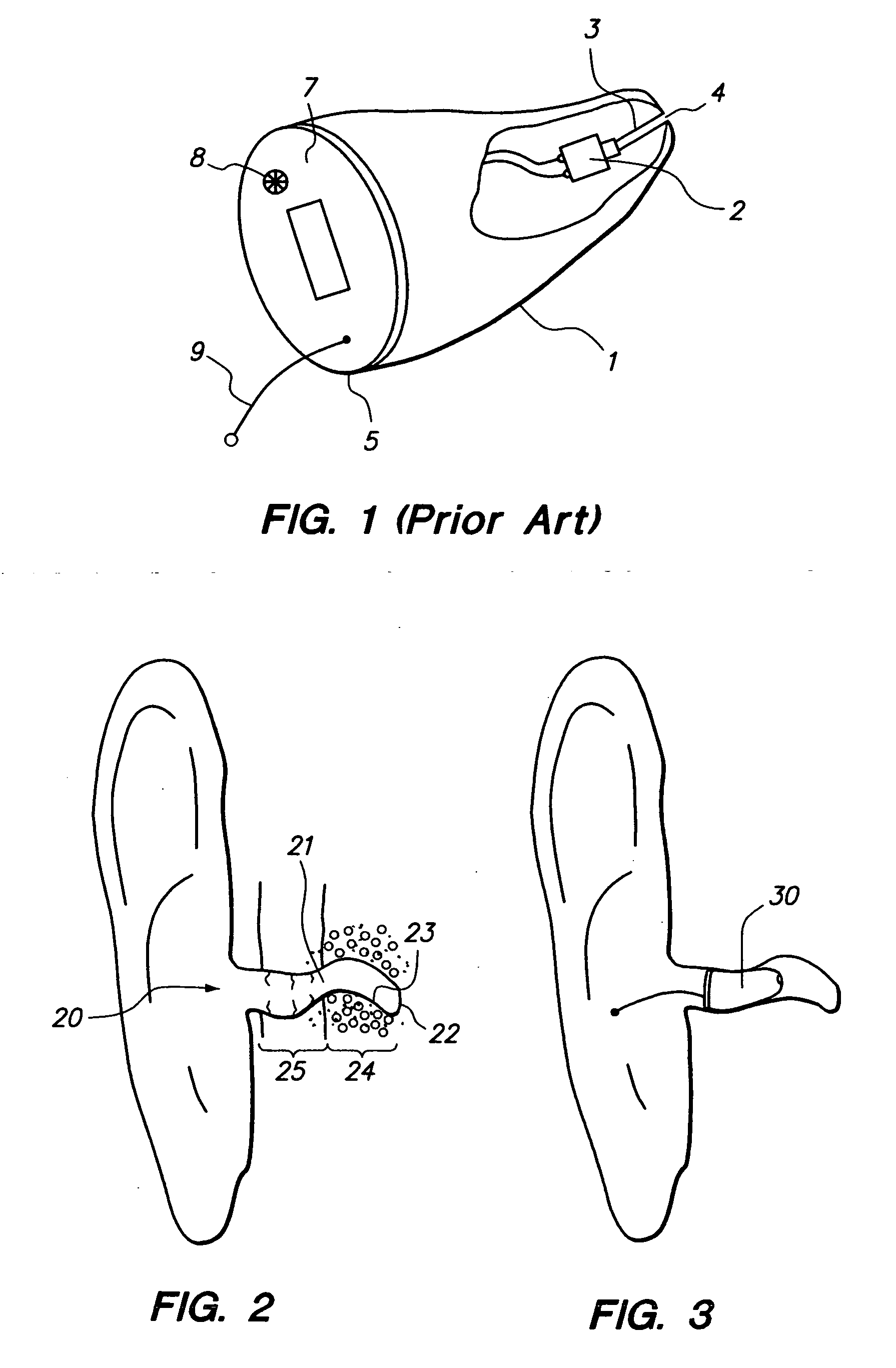 Open fit canal hearing device