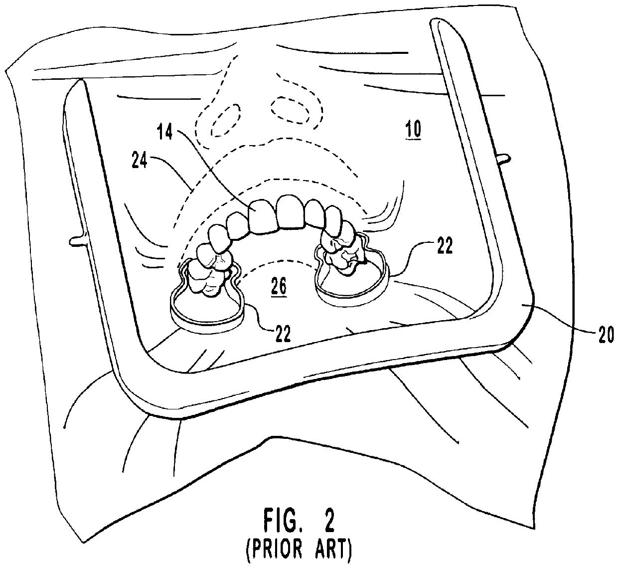 Polymerizable isolation barriers containing reflective materials and methods for forming and using such barriers