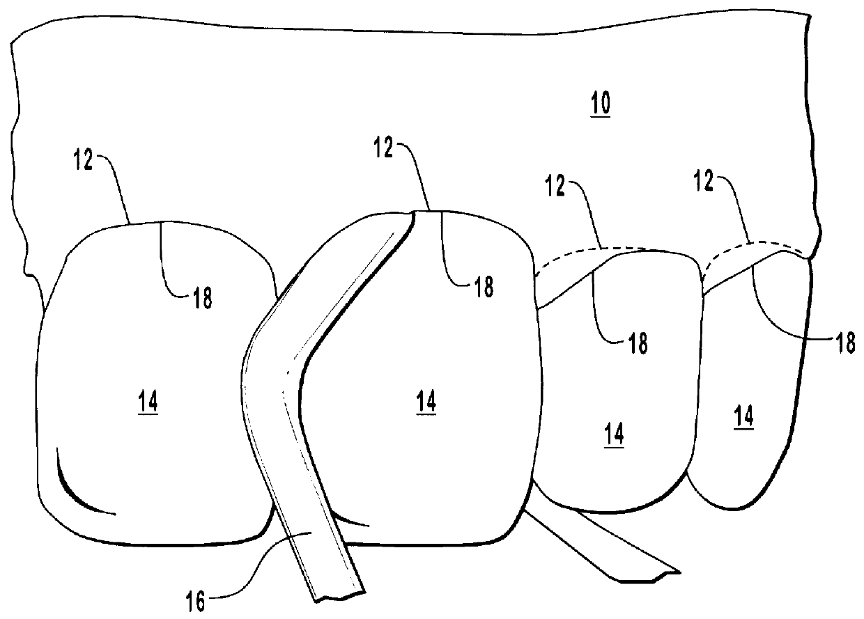 Polymerizable isolation barriers containing reflective materials and methods for forming and using such barriers