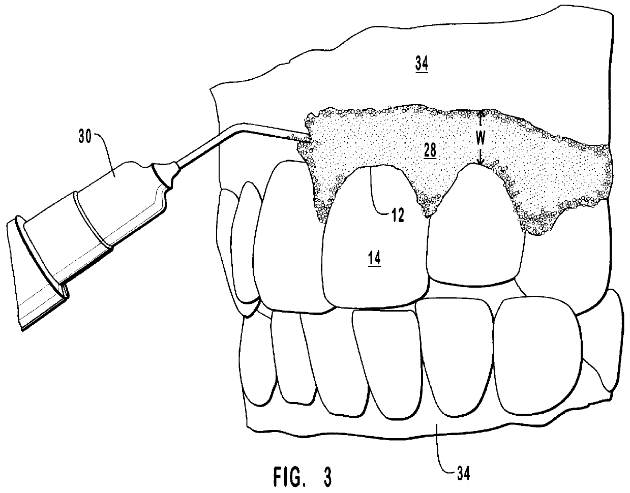 Polymerizable isolation barriers containing reflective materials and methods for forming and using such barriers