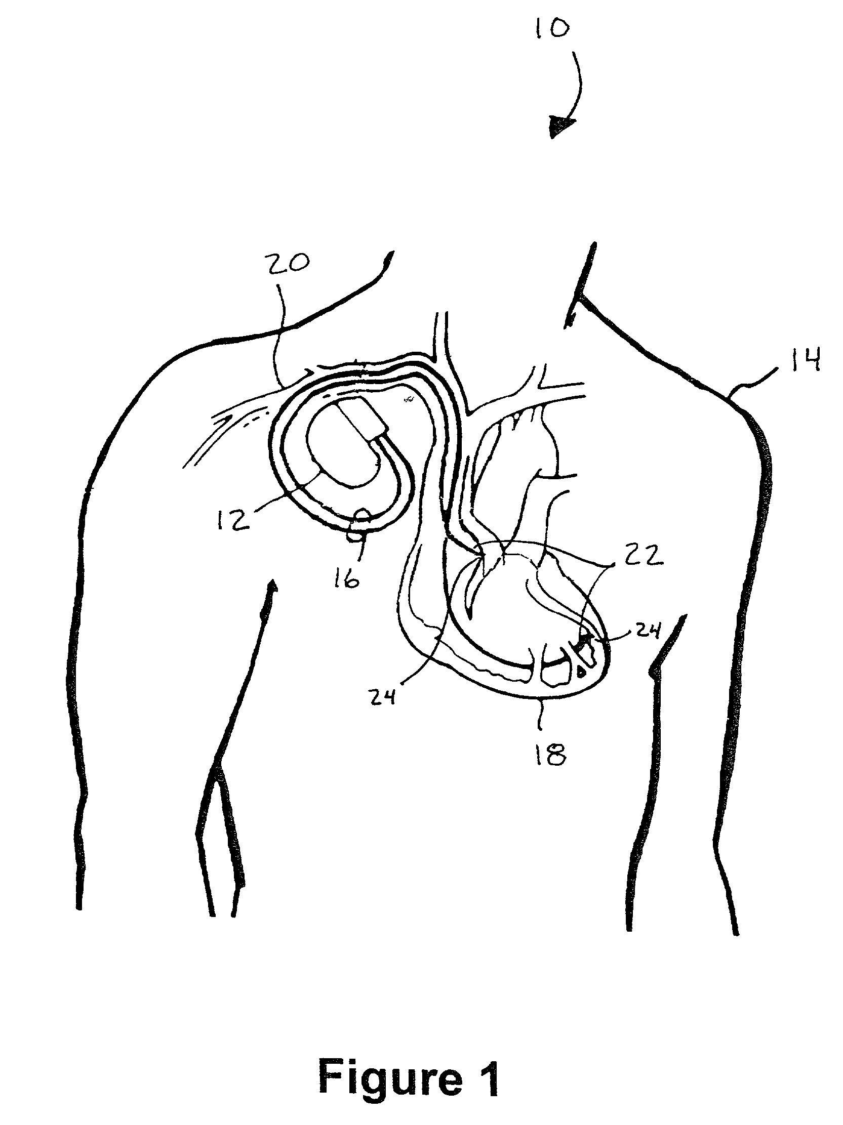 Method and apparatus for shielding coating for MRI resistant electrode systems