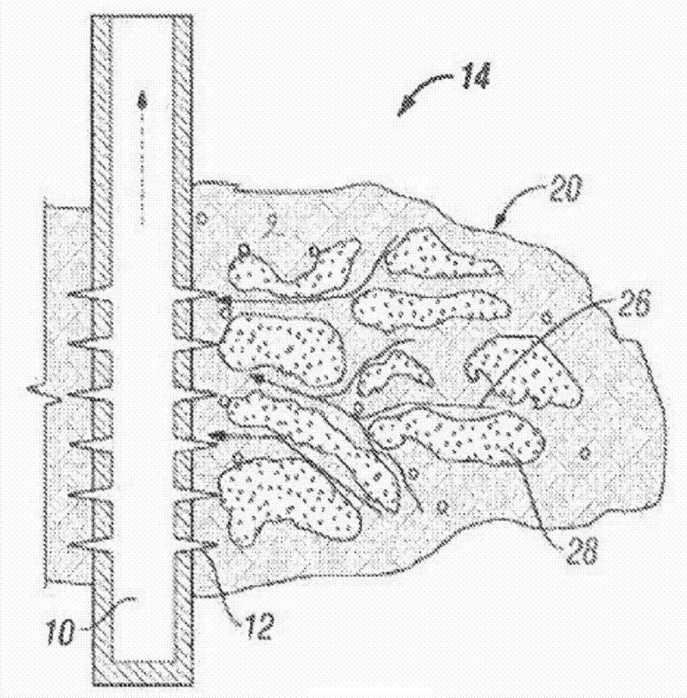 Heterogeneous proppant placement in a fracture with removable extrametrical material fill