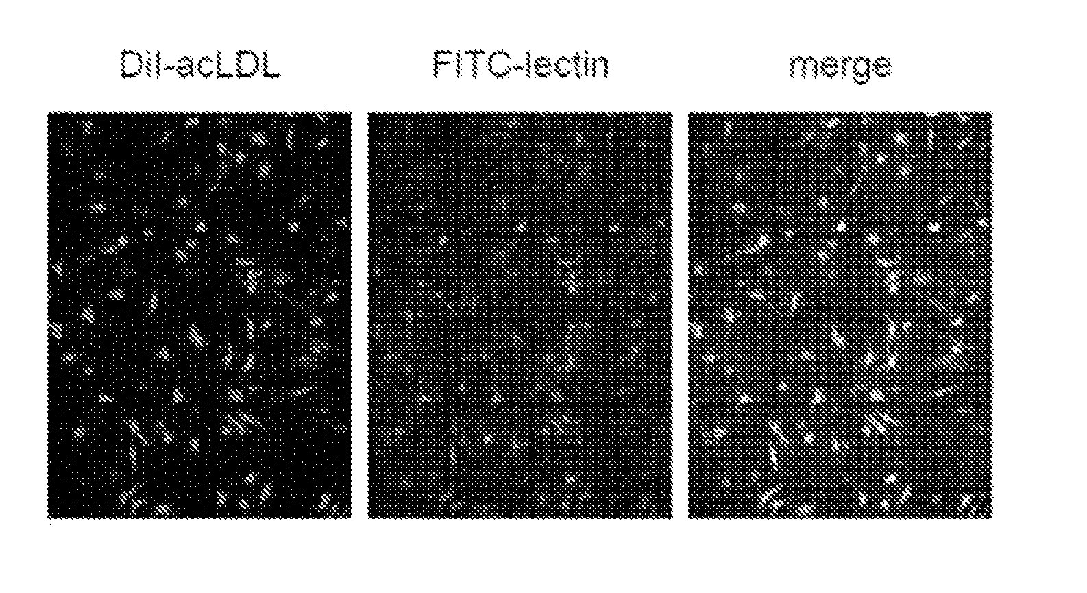 Anticancer therapy by transplanting vascular endothelial progenitor cells