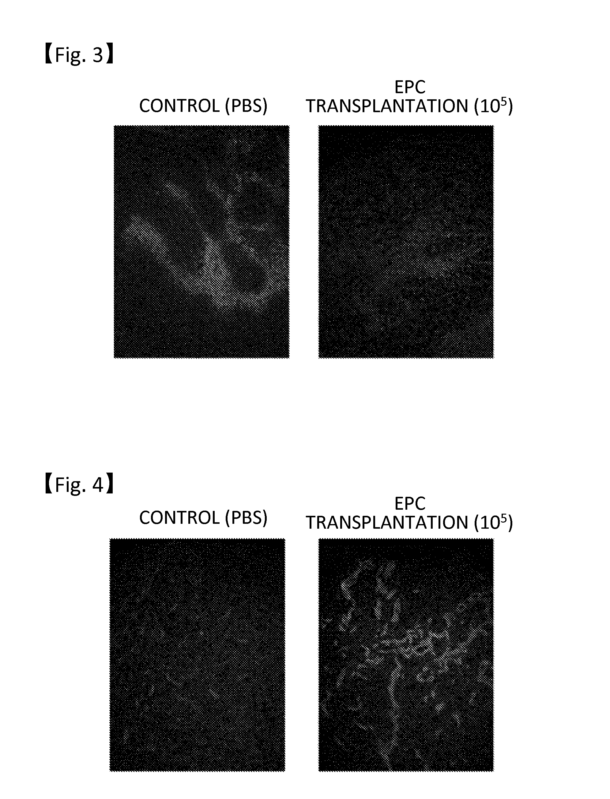 Anticancer therapy by transplanting vascular endothelial progenitor cells