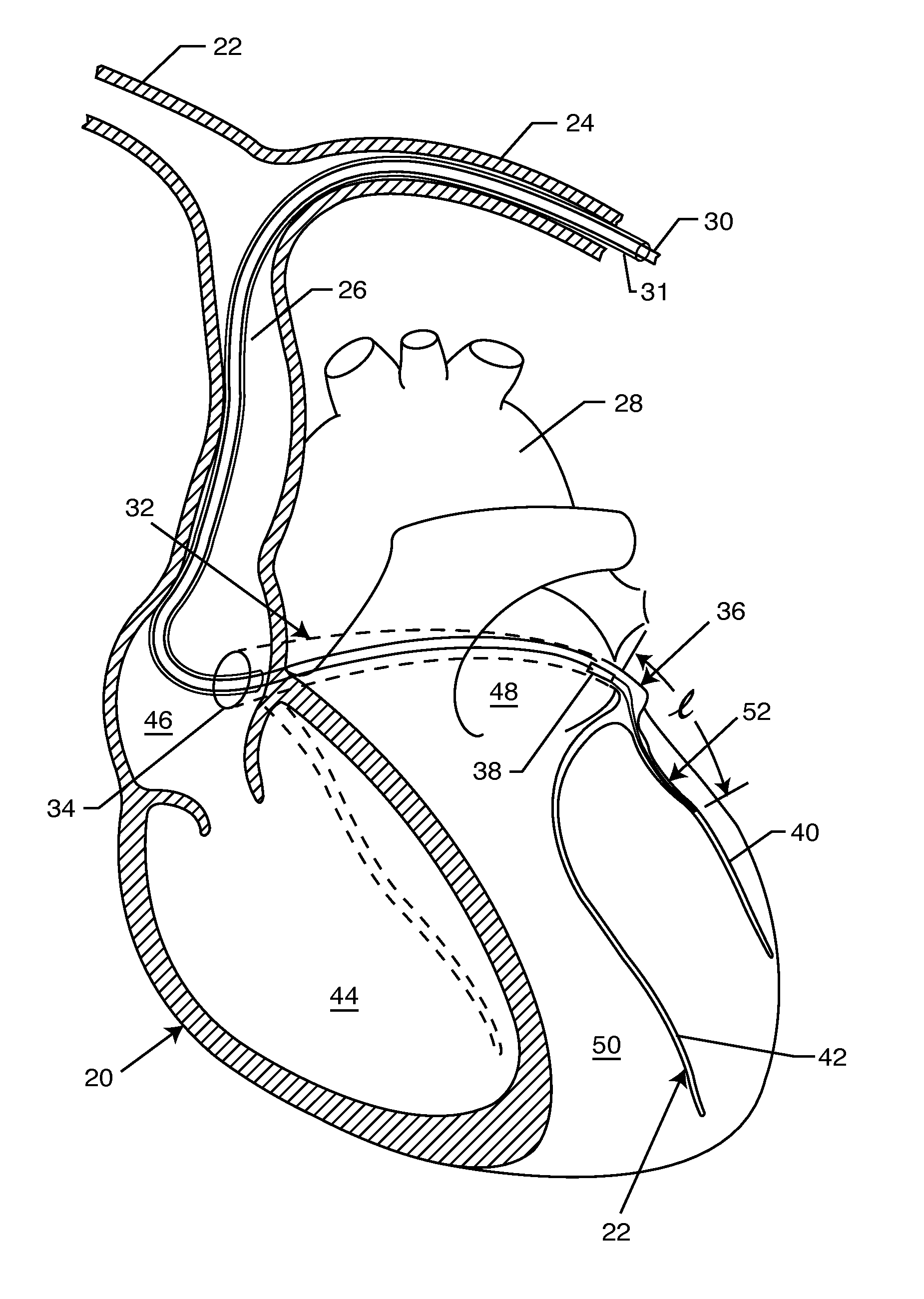 Medical lead system utilizing electromagnetic bandstop filters