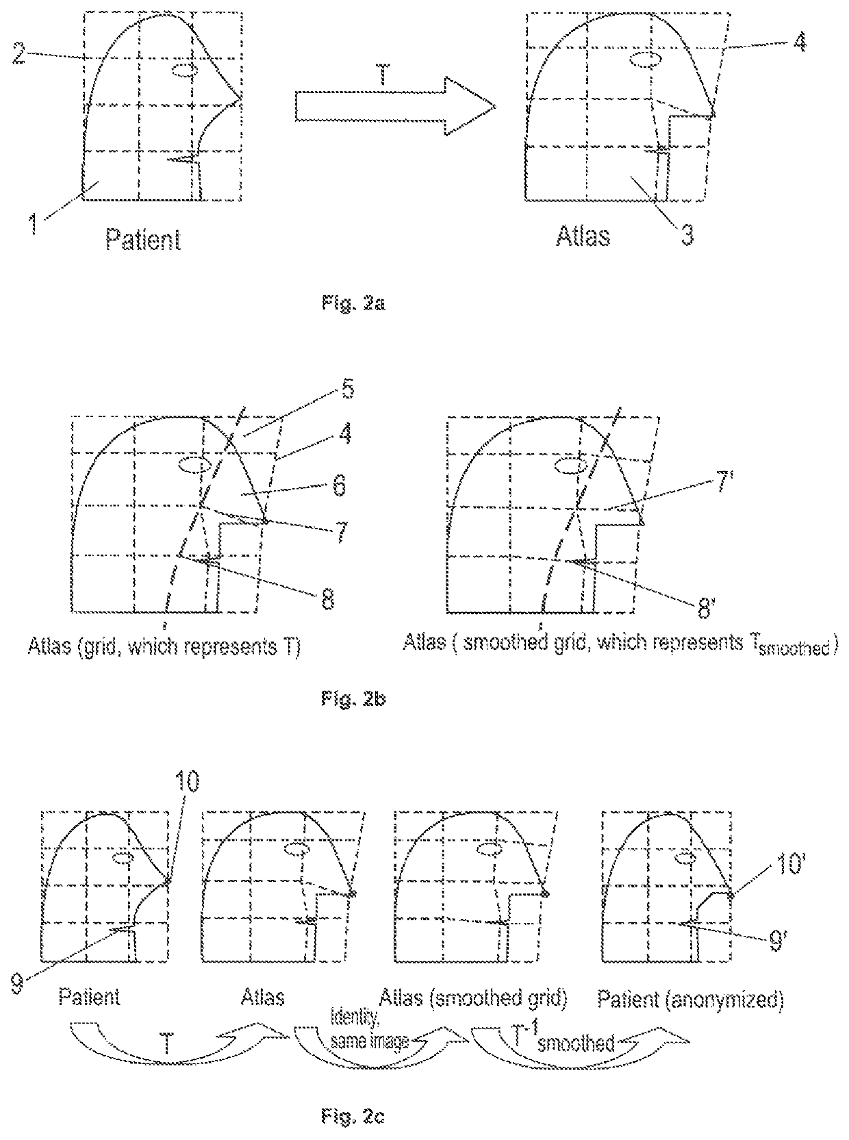 Anonymisation of medical patient images using an atlas