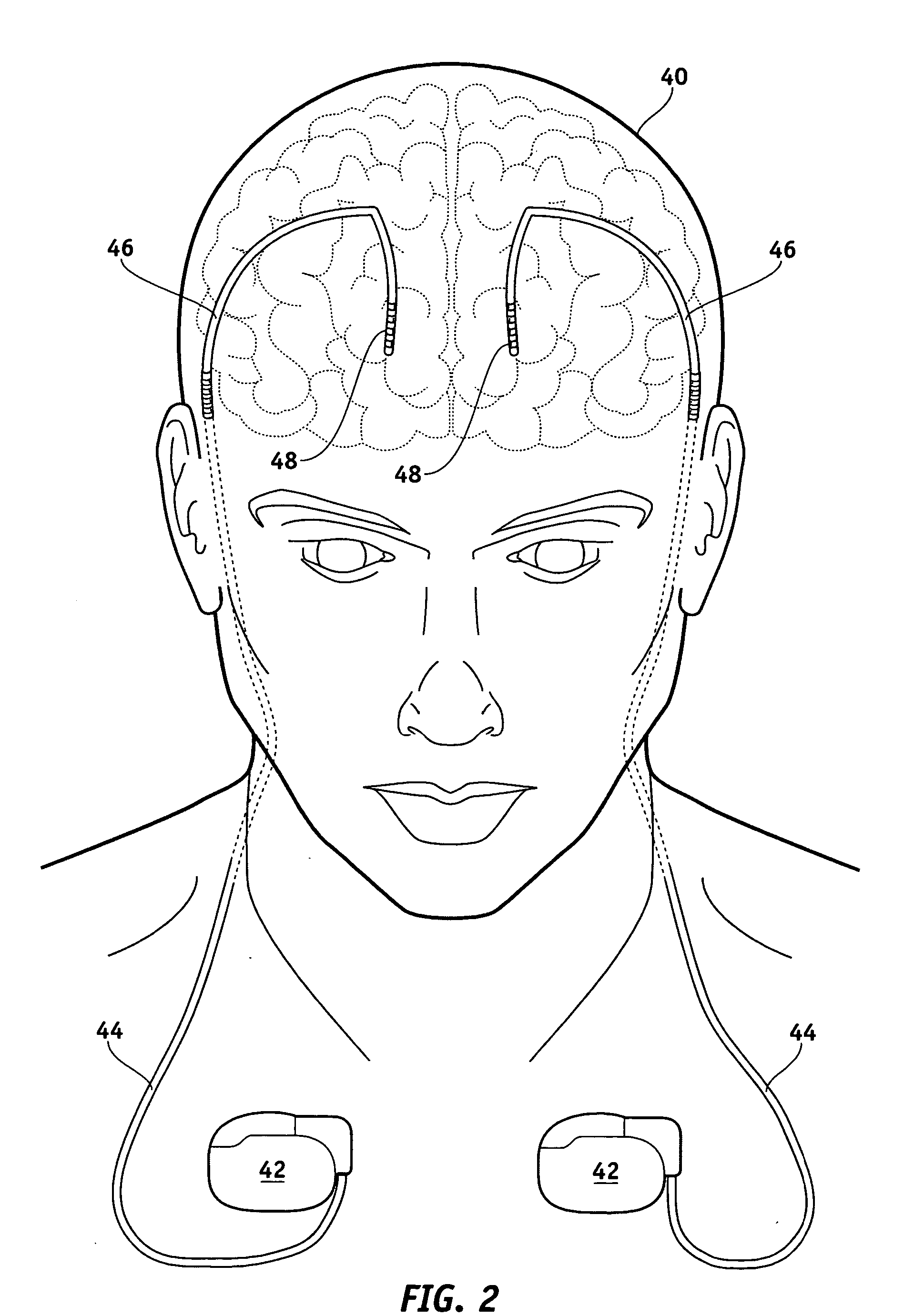 MRI-safe implantable medical device