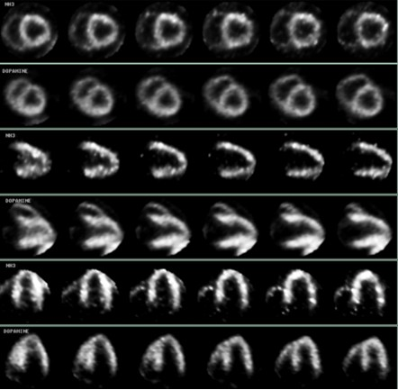 Use of carbon-11 marked N-methyldopamine hydrochloride in preparation of positron medicinal imaging agent