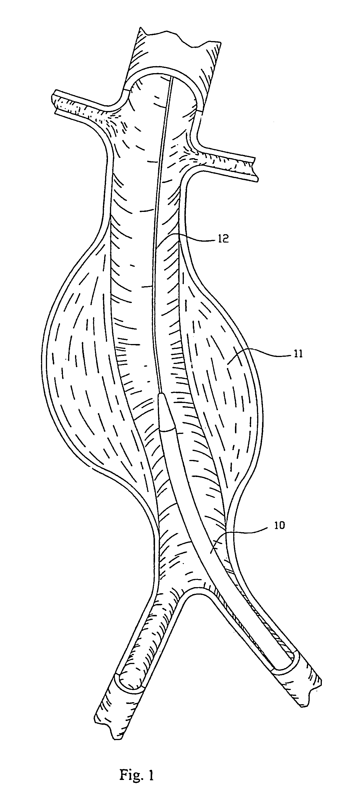 Intraluminal prosthesis attachment systems and methods