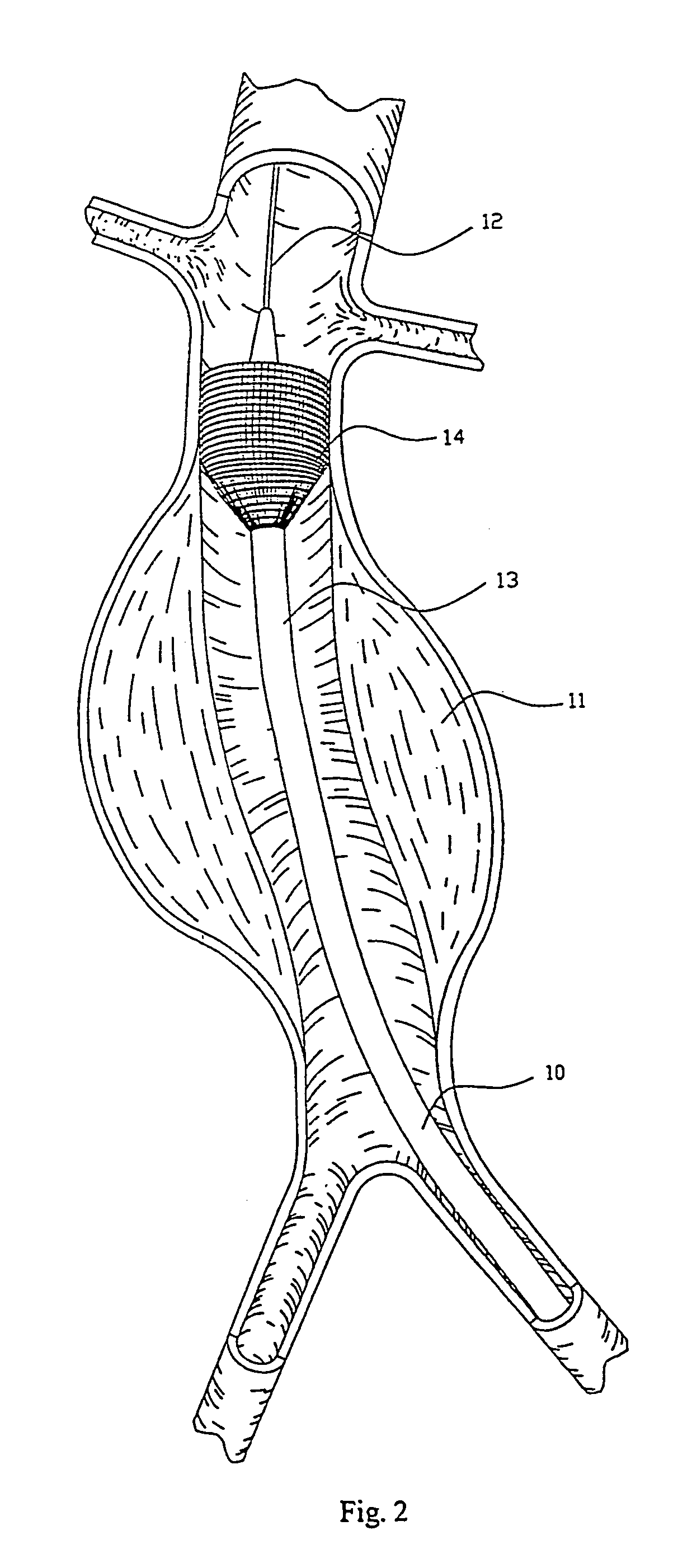 Intraluminal prosthesis attachment systems and methods