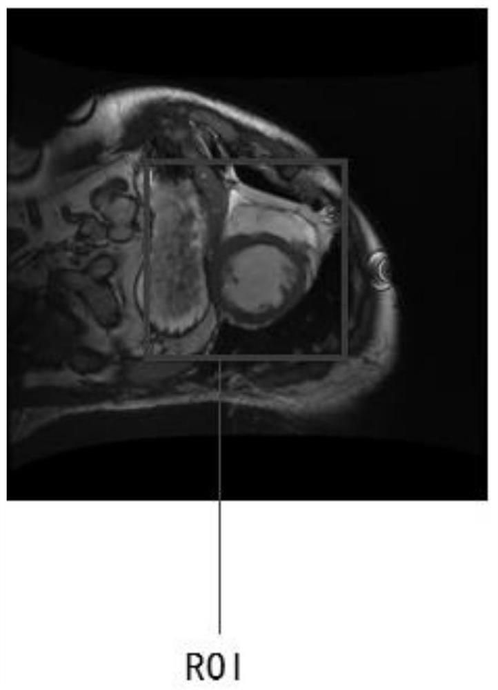 Segmentation method of epicardium and epicardium in cardiac functional magnetic resonance images