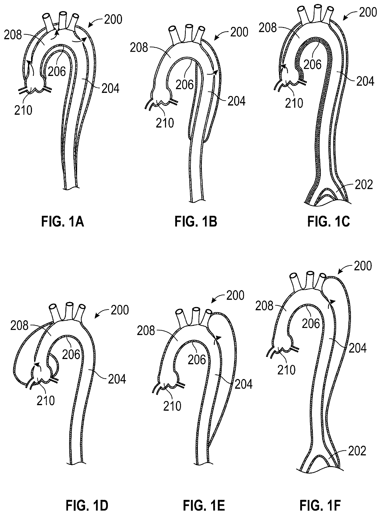 Aortic dissection implant