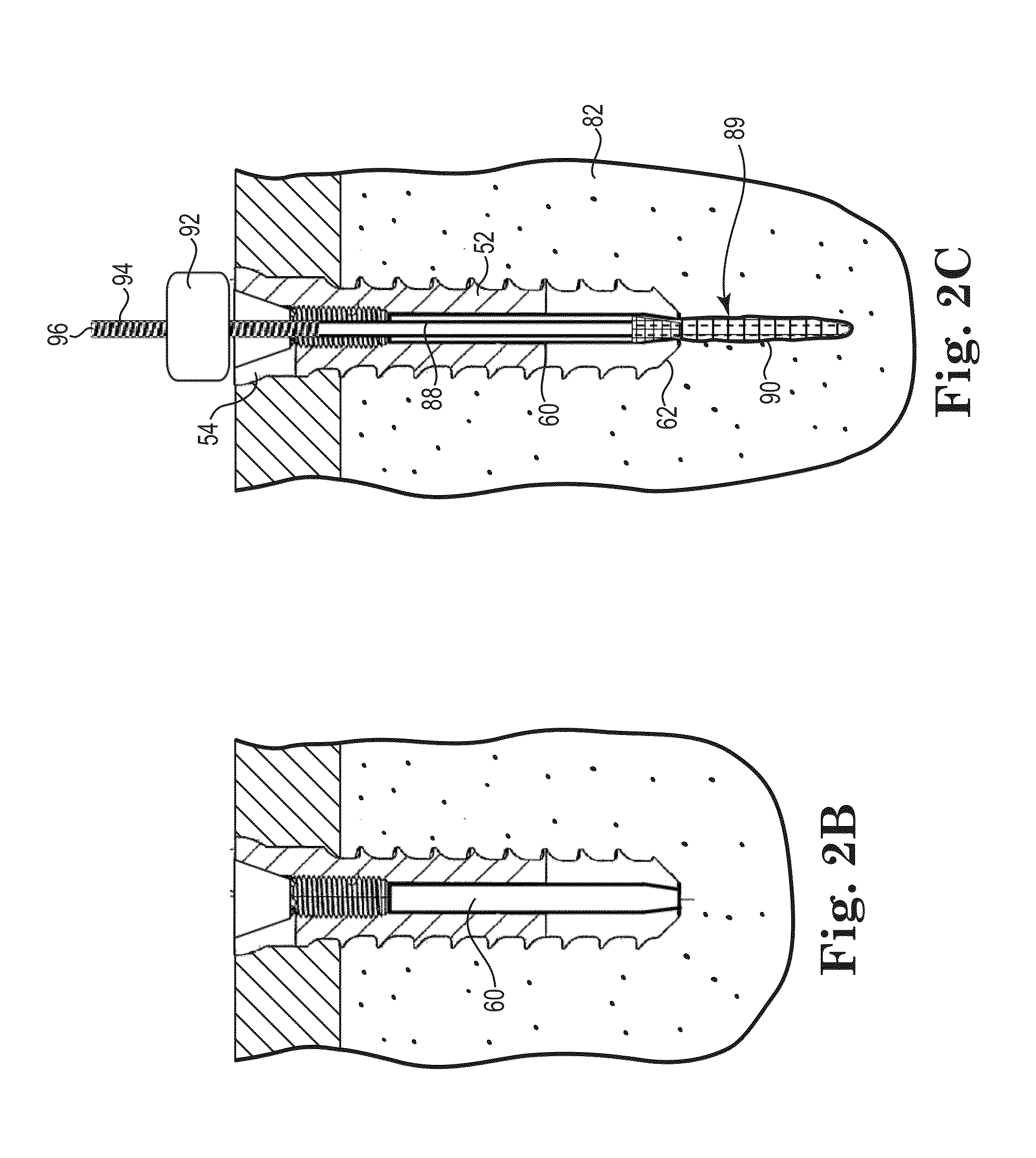 Fixation system for orthopedic devices