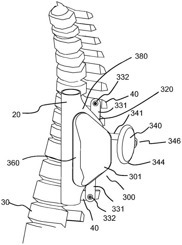 Thoracic aorta ventricular assist system