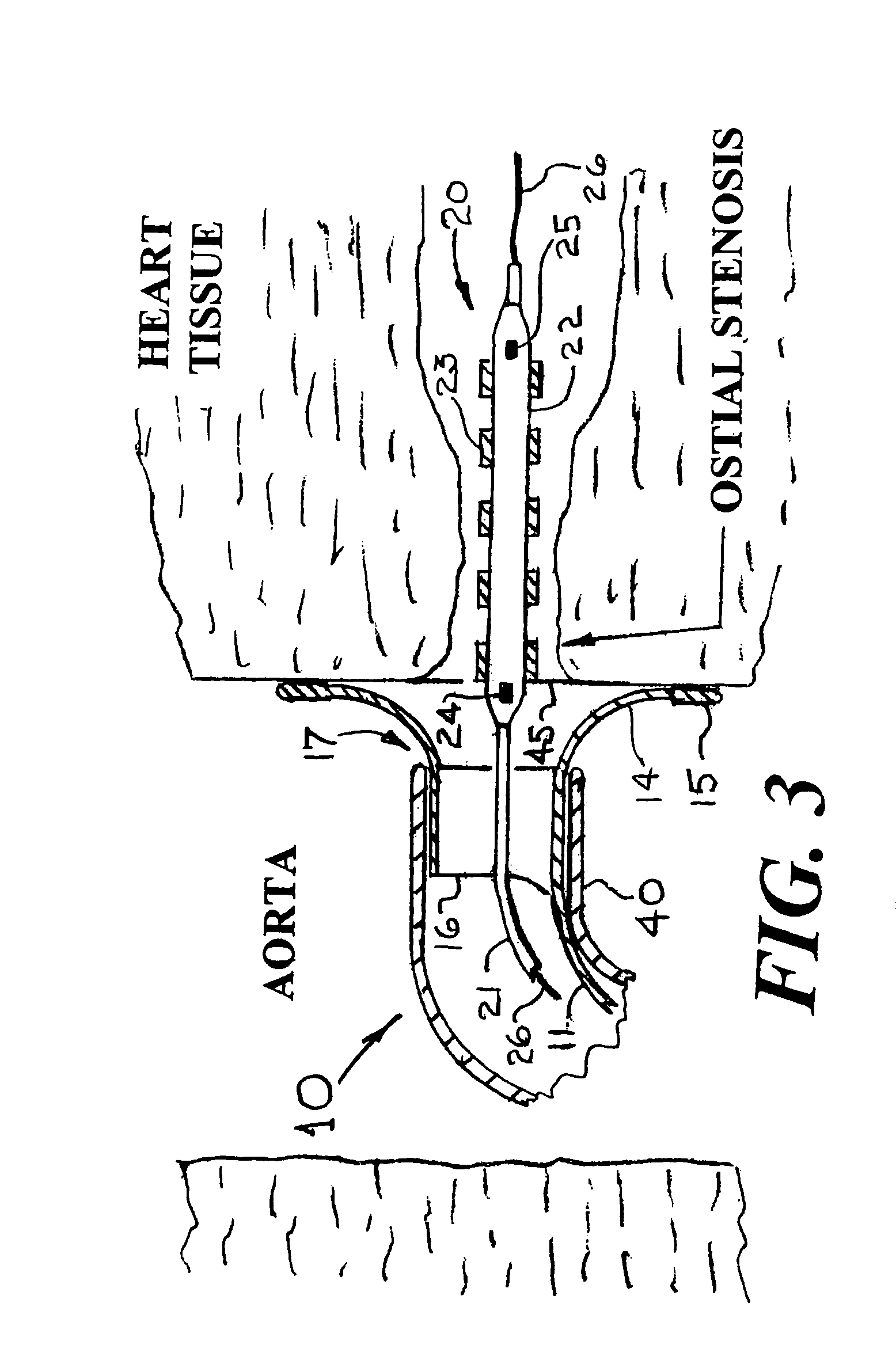 Means and method for the accurate placement of a stent at the ostium of an artery