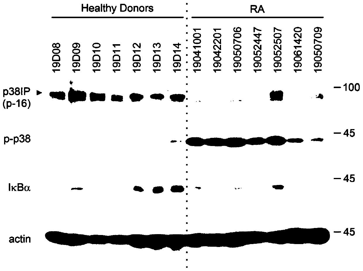 Rheumatoid arthritis diagnostic marker and application thereof