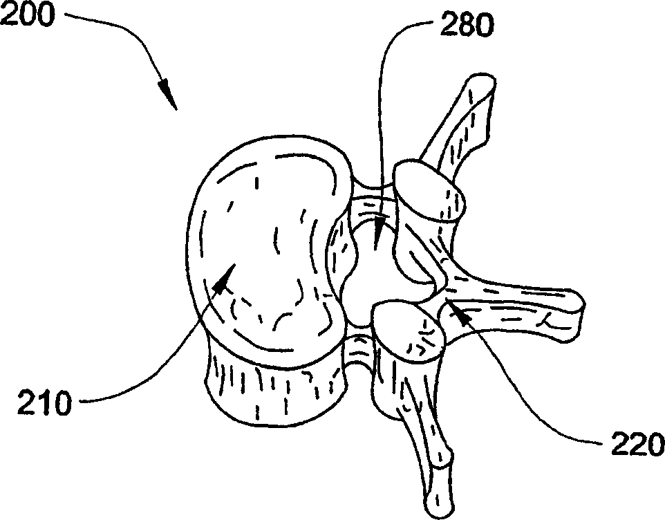 Laminoplasty devices and methods