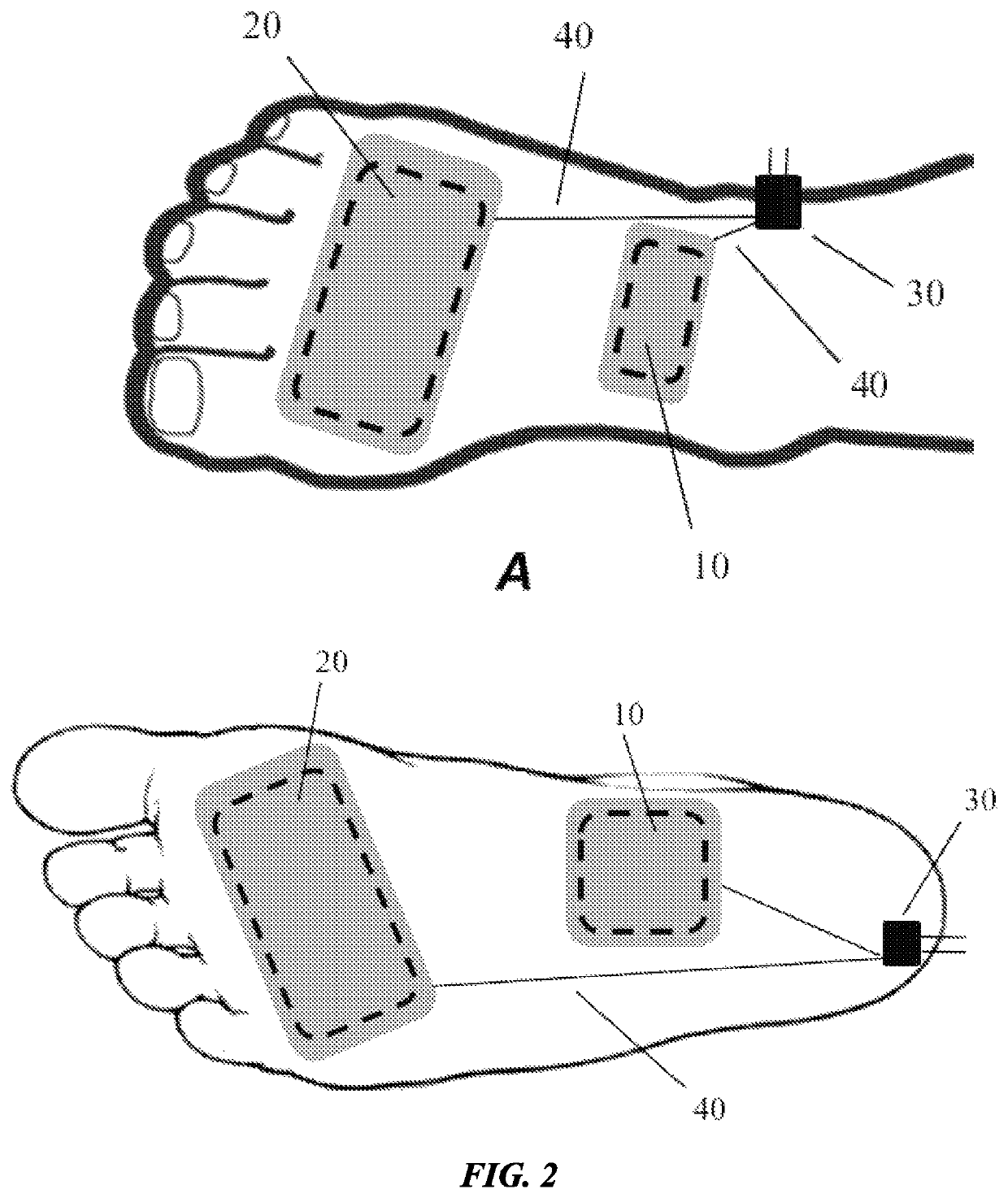 Peripheral neuromodulation to treat bladder and bowel dysfunction