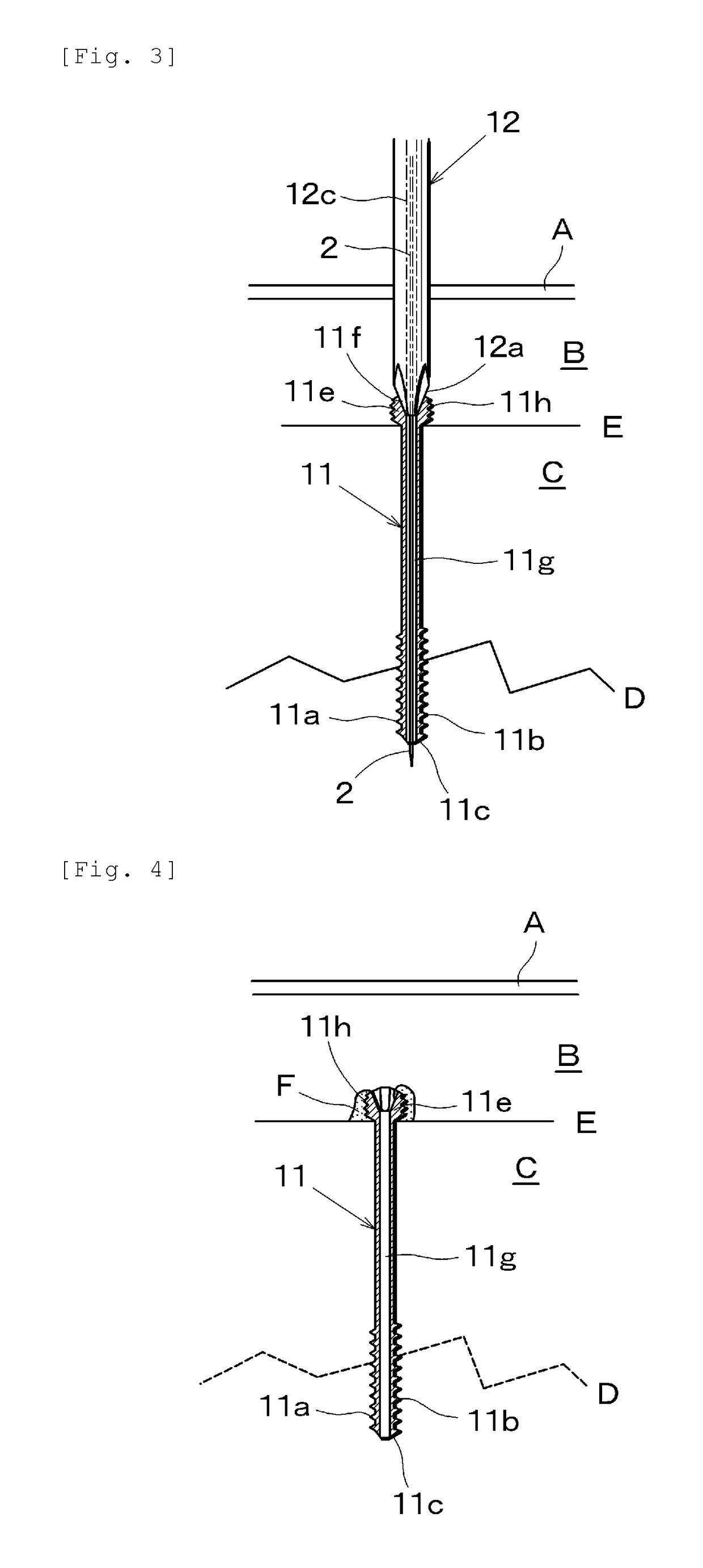 Medical screw