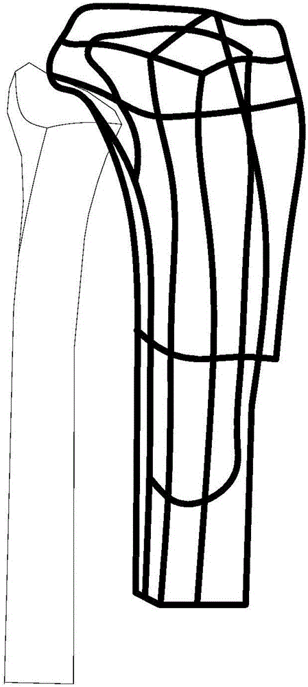 Designing and forming method for anatomical bone plate of individuation bone model