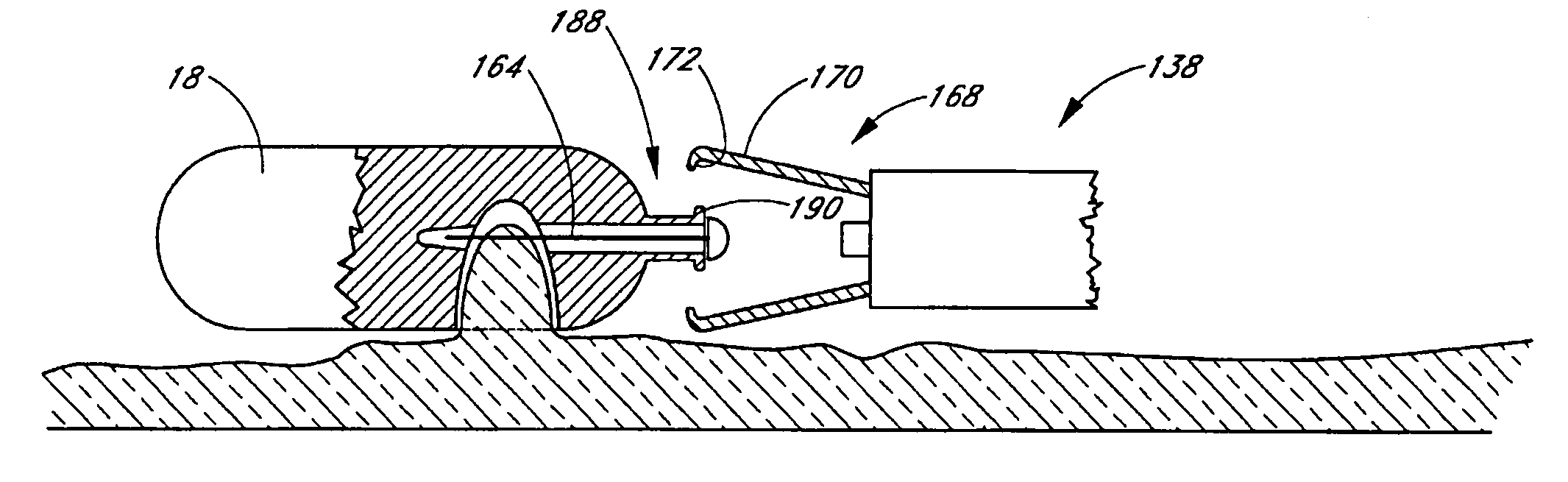 Implantable monitoring probe