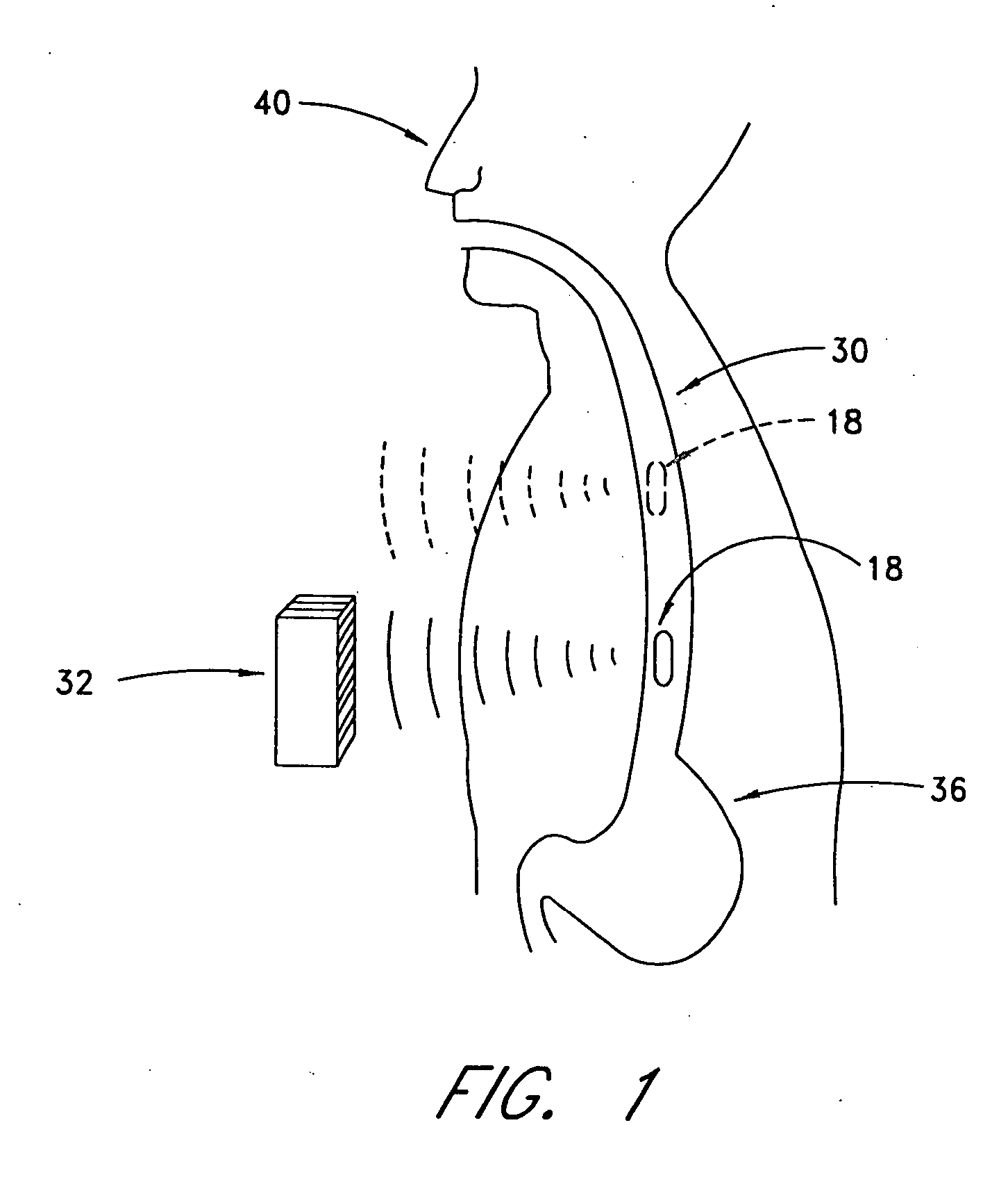 Implantable monitoring probe