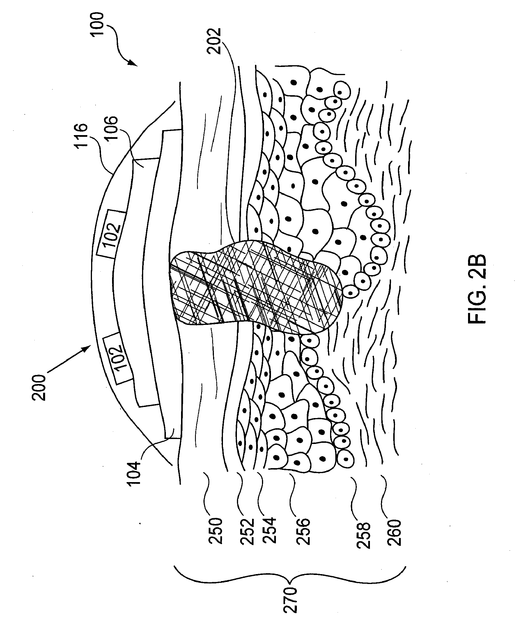 Devices, Methods and Kits for Radiation Treatment via a Target Body Surface