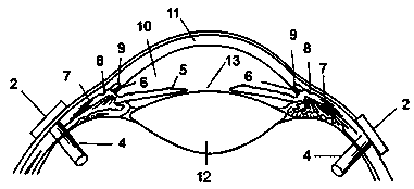 Method and device for reducing intraocular VEGF concentration