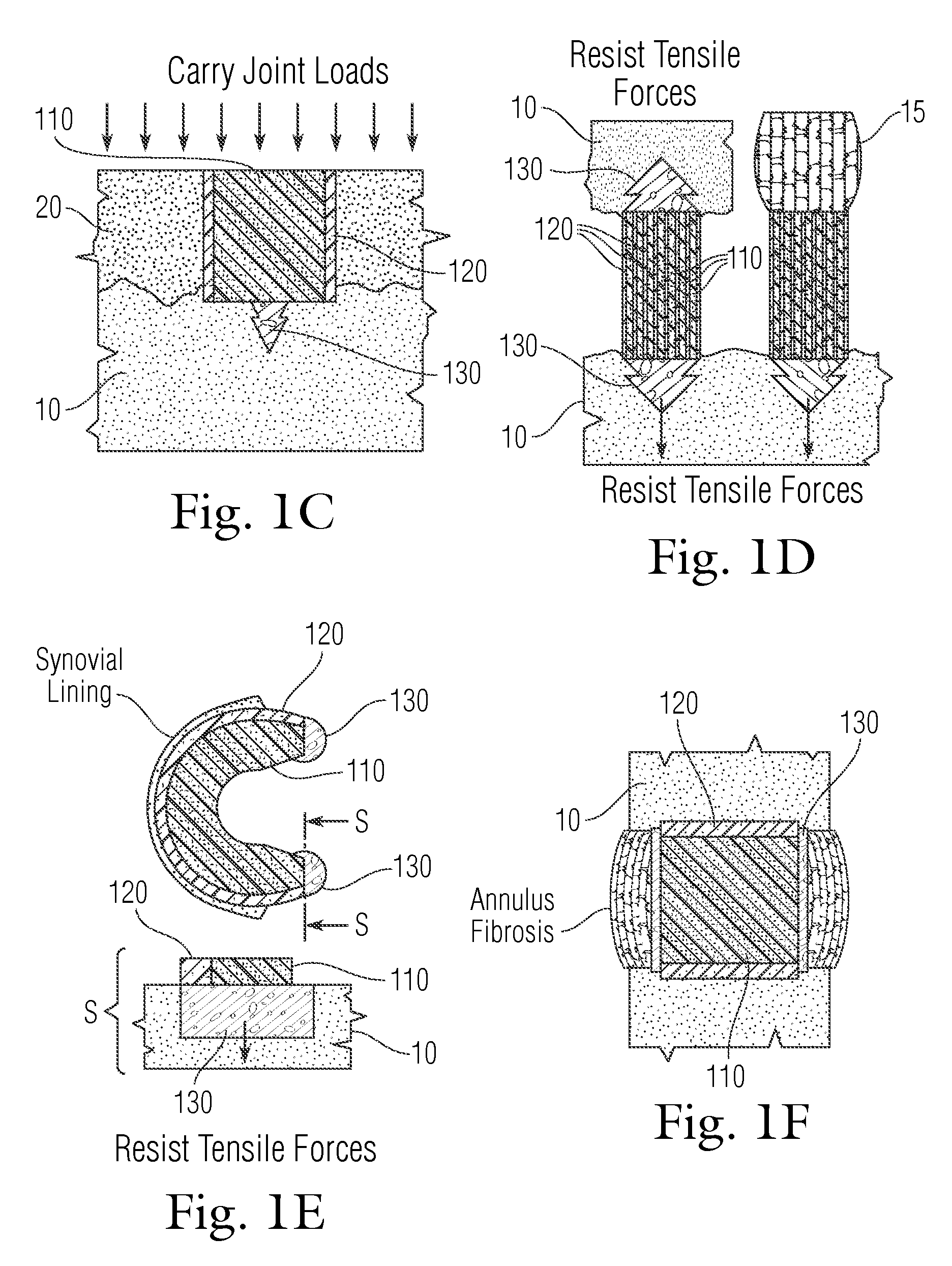 Multi-component non-biodegradable implant, a method of making and a method of implantation