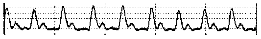 Non-invasive blood pressure detection device based on the combination of photoelectric green light pulse and electrocardiogram